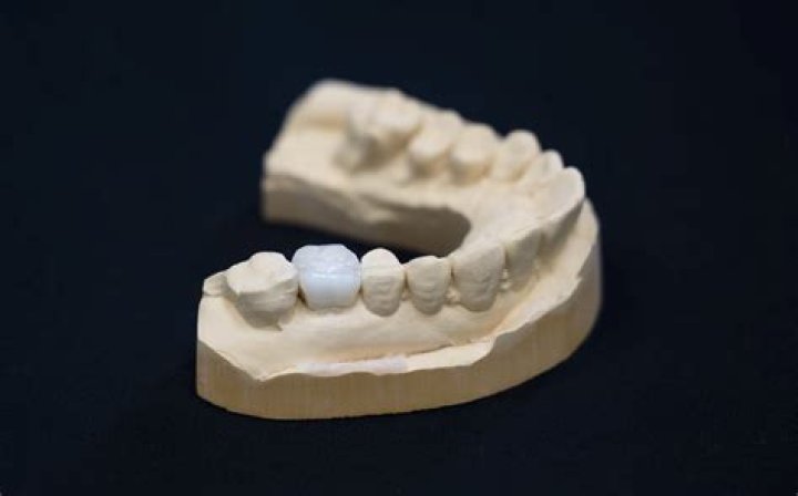 Artificial intelligence can help to create customised dental crowns within seconds, team led by HKU scientists says