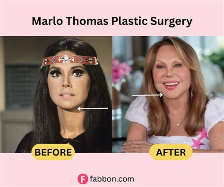 Before and After Marlo Thomas Plastic Surgery