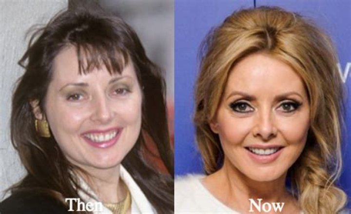 Carol Vorderman Surgery: A Comprehensive Look At Her Journey And Transformation