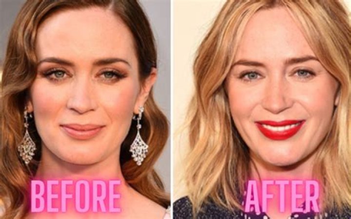 Emily Blunt Chirurgie