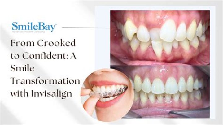 From Crooked to Confident: Transforming Your Smile with Braces
