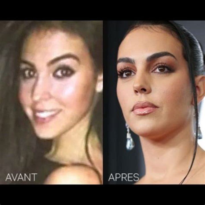 Has Georgina Rodriguez Had Plastic Surgery?