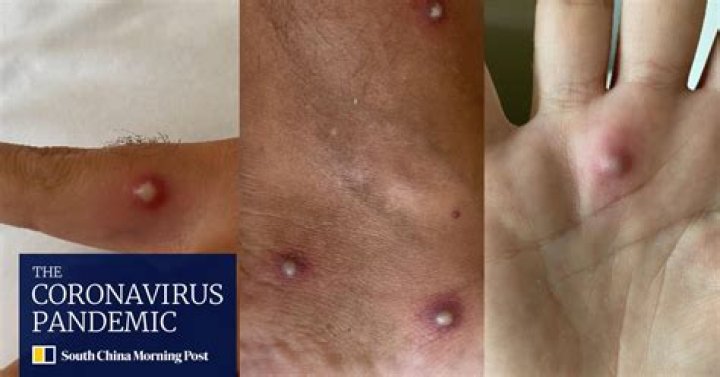 Italian man diagnosed with Covid-19, monkeypox and HIV in a single day