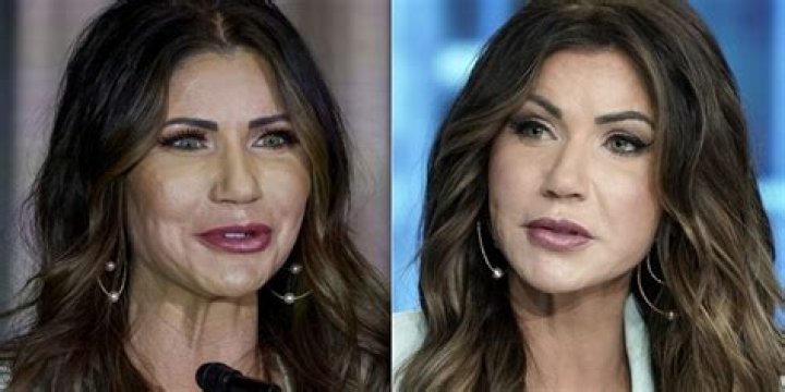 Kristi Noem Before And After Cosmetic Surgery: A Comprehensive Look