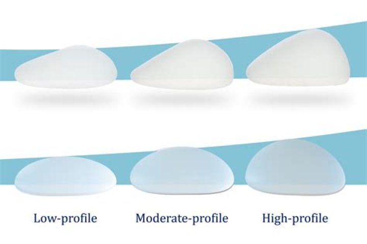 	SILICONE BRA: AN ALTERNATIVE TO IMPLANTS	