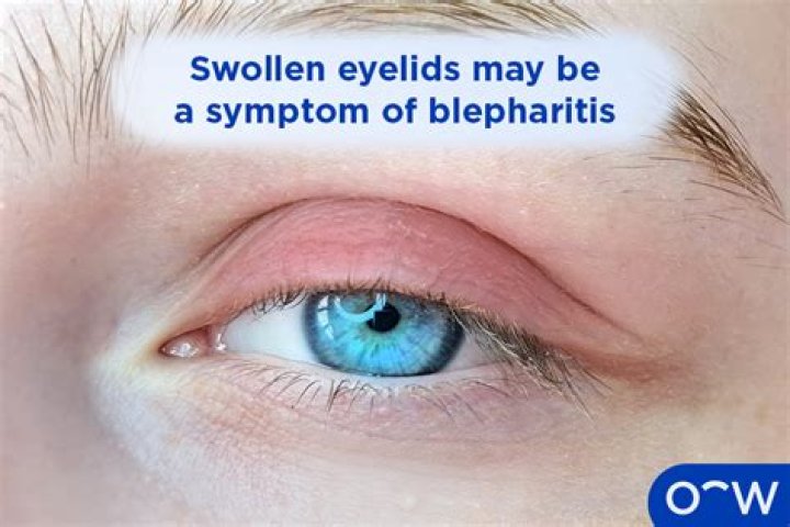 Switchword Chronic Blepharitis [Eyelid] Meaning