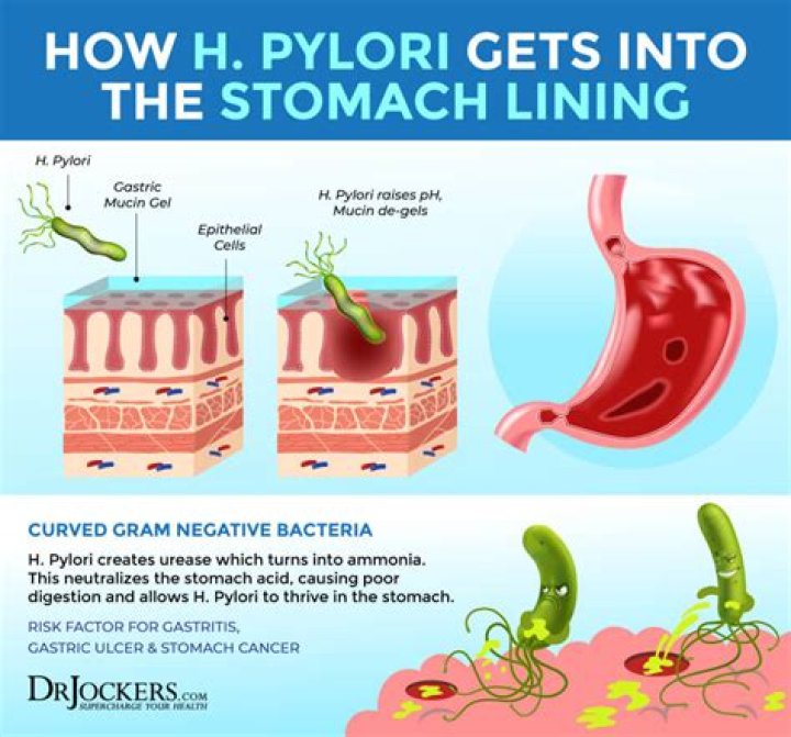 	The natural way to ease your H. pylori infection	