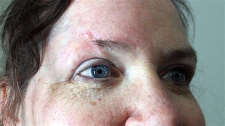 Understanding Scars Between Eyebrows: Causes, Treatments, And Care
