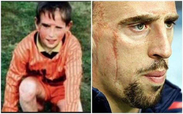 Unveiling The Story Behind Ribery's Scar