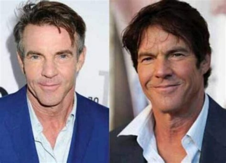 Unveiling The Truth Behind Dennis Quaid's Plastic Surgery Journey