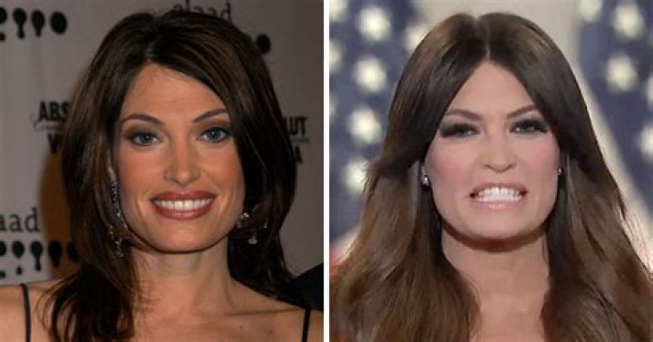 Unveiling The Truth Behind Kimberly Guilfoyle's Plastic Surgery Journey
